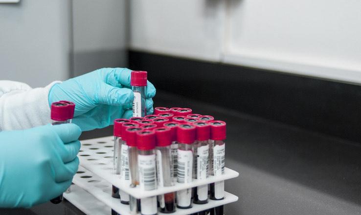 Alterity Therapeutics Reaches Key Milestone in Phase 2 MSA Trial, Topline Data Expected Mid-2025